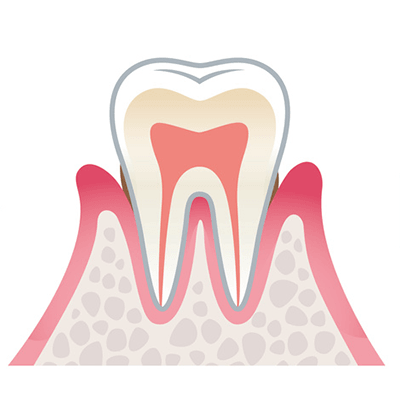 軽度歯周病